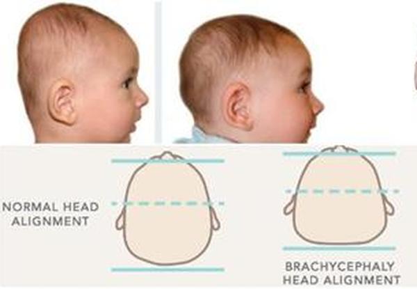 Plagiocefali – avflatet hode