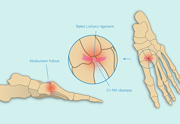 Subtile Lisfranc-skader